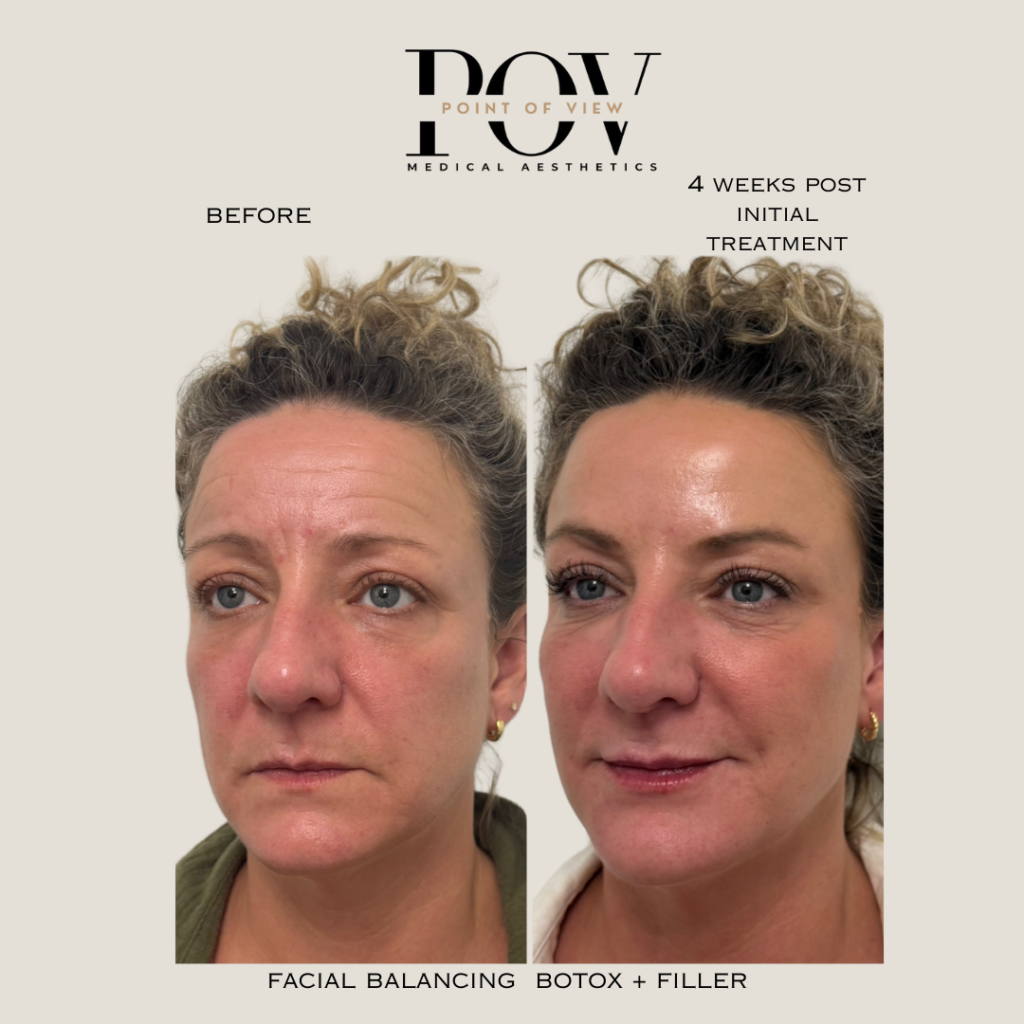 Side-by-side comparison showing a womans face before and after facial balancing treatment with Botox and filler, four weeks apart.