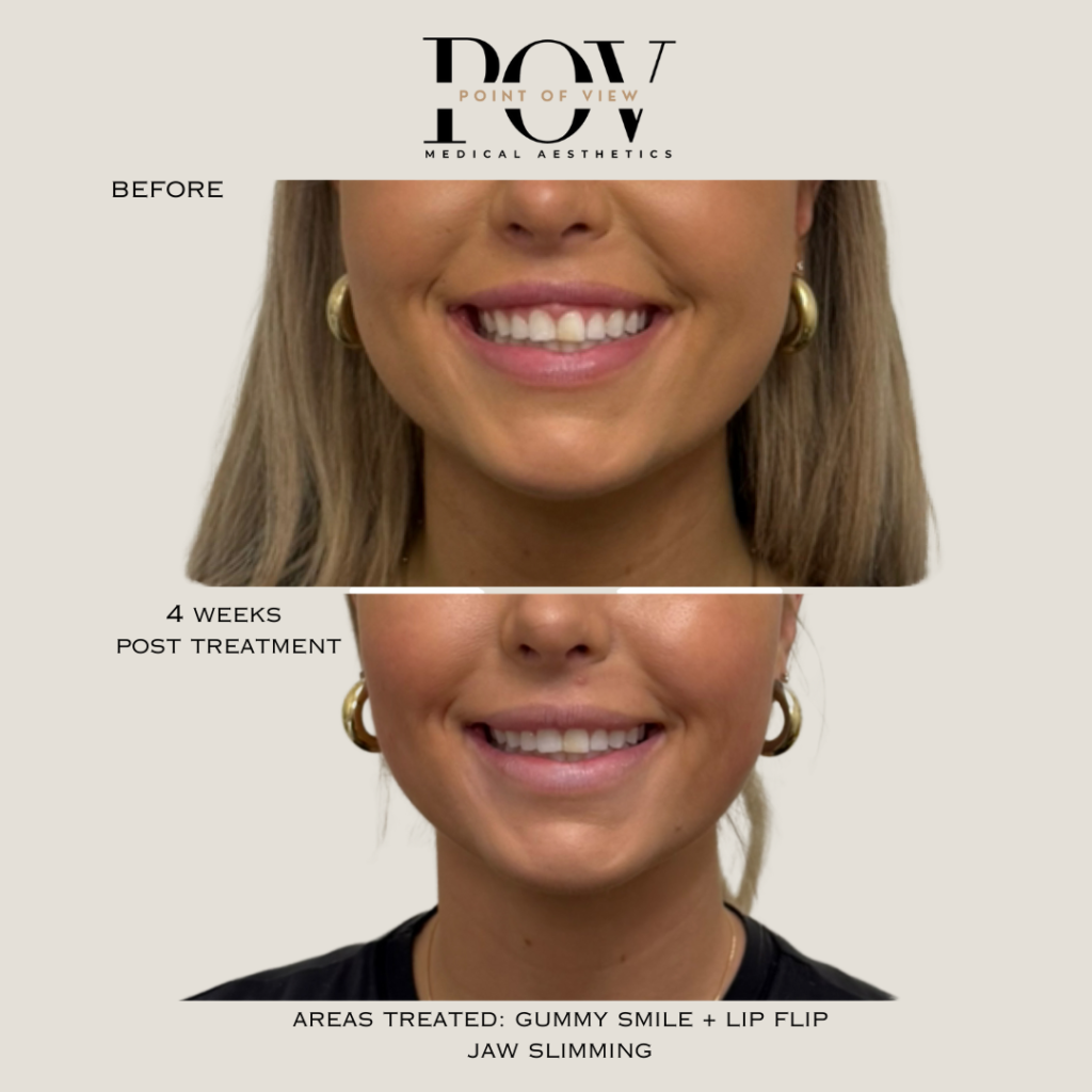 Before and after images of a womans smile, showcasing the results of gummy smile and lip flip treatment, as well as jaw slimming, 4 weeks post-procedure.