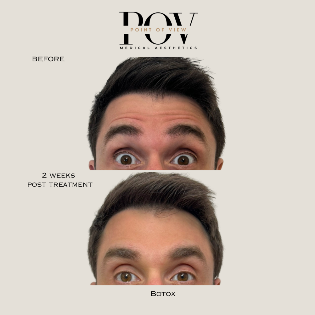 Before and after images of a persons forehead and eyes showing results of Botox treatment over two weeks.