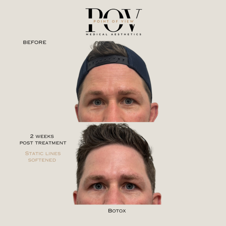 Top and bottom comparison of a mans forehead before and after two weeks of Botox treatment. Static lines appear softened in the after image.