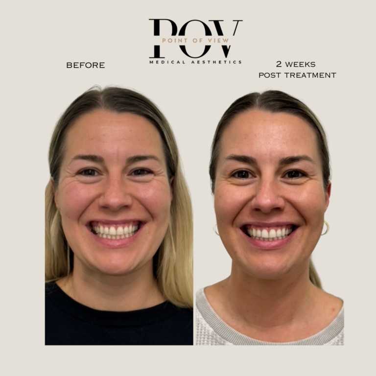 Side-by-side comparison of a womans face before and two weeks after a medical aesthetics treatment.