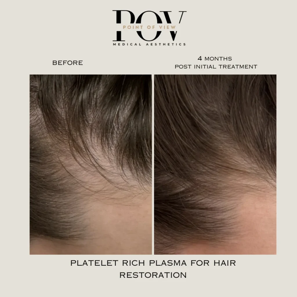 Platelet Rich Plasma for hair restoration