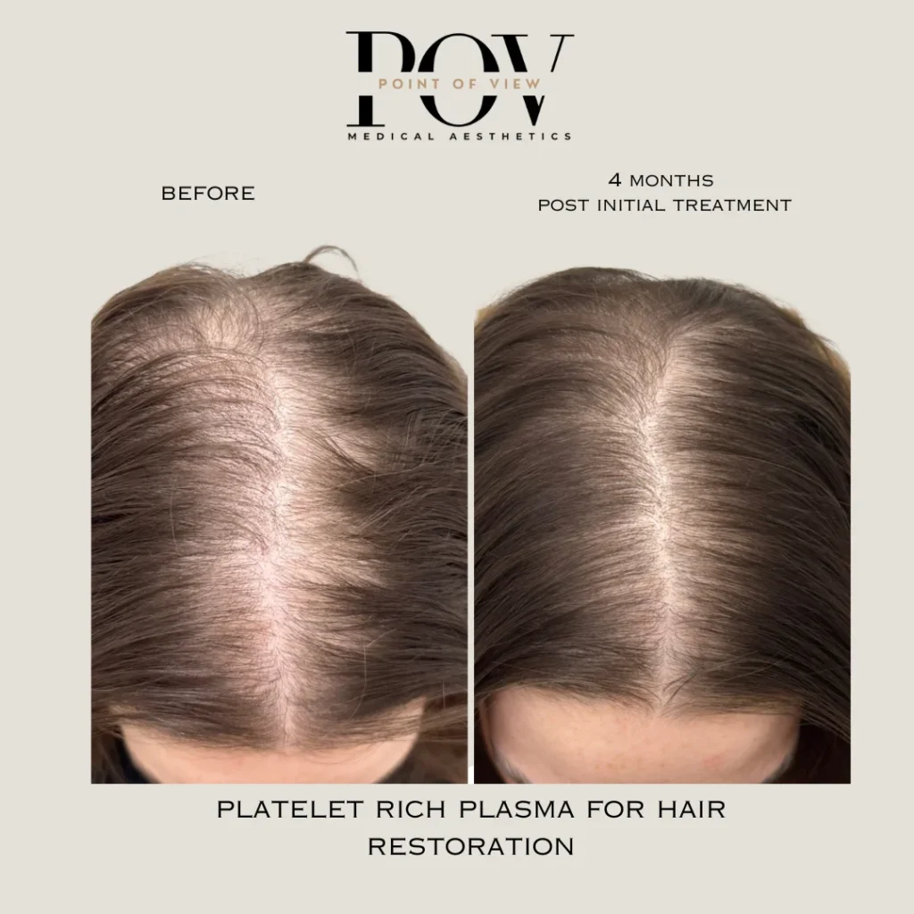 Before and after comparison of a persons scalp showing hair density improvement with Platelet Rich Plasma treatment over four months.