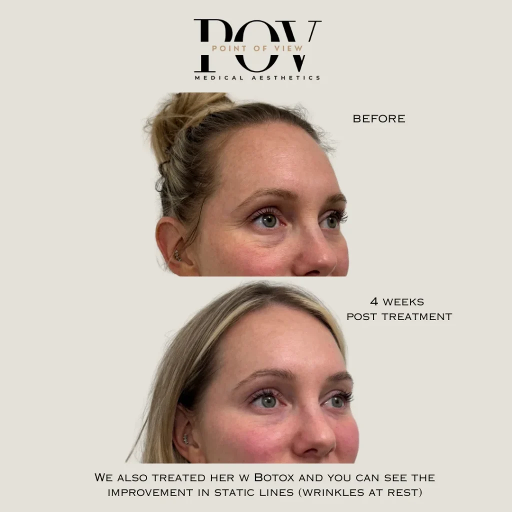 Two side-by-side photos comparing a womans forehead before and 4 weeks after PRP treatment, highlighting reduced static lines and smoother skin.