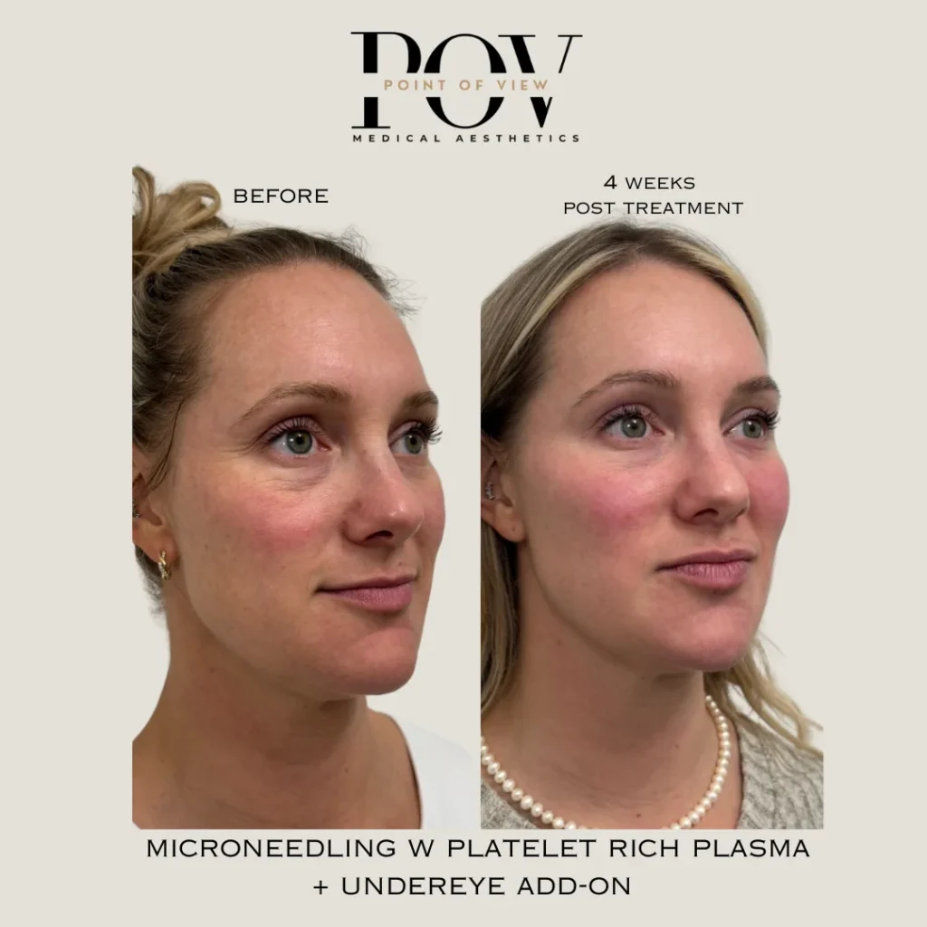 Side-by-side comparison of a womans face before and 4 weeks after microneedling with platelet-rich plasma and undereye treatment. Side-by-side comparison of a womans face before and 4 weeks after microneedling with platelet-rich plasma and undereye treatment.