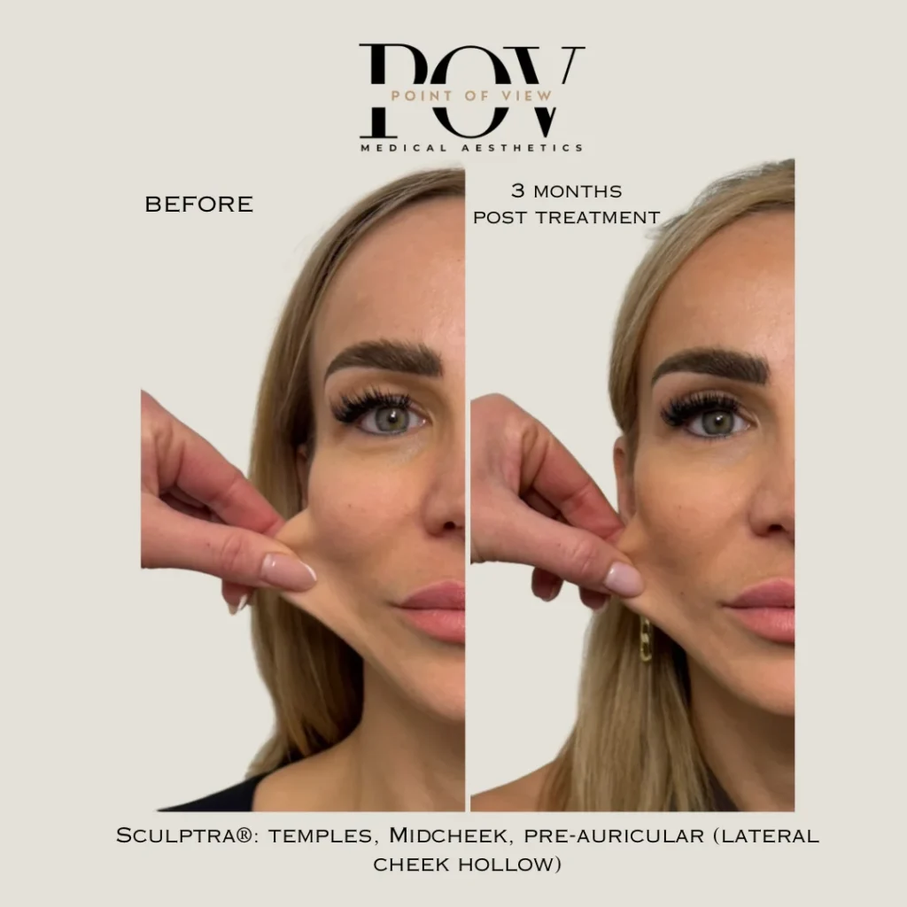 Side-by-side image comparison showing a womans facial skin before and 3 months after Sculptra treatment, illustrating changes in skin tightness.