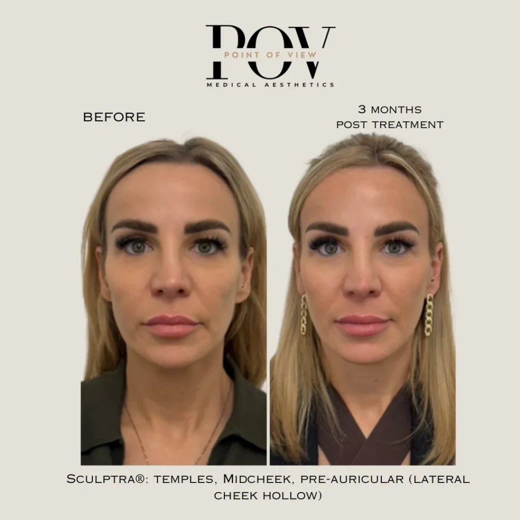 Before-and-after photos of a woman. Left: before treatment. Right: three months post Sculptra® to temples, midcheek, and pre-auricular areas.