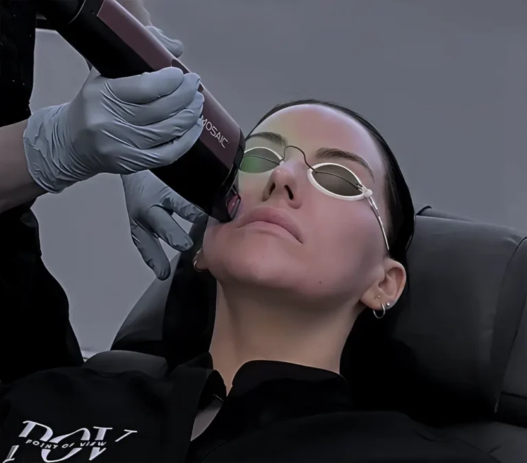 Woman receiving the Mosaic 3D laser treatment to her face at Point of View Medical Aesthetics