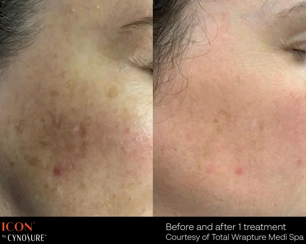 Icon IPL treatment to treat acne scaring and pigmentation issues.