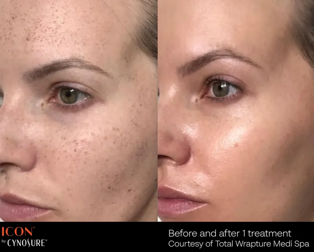 Icon IPL treatment to treat pigmentation issues.