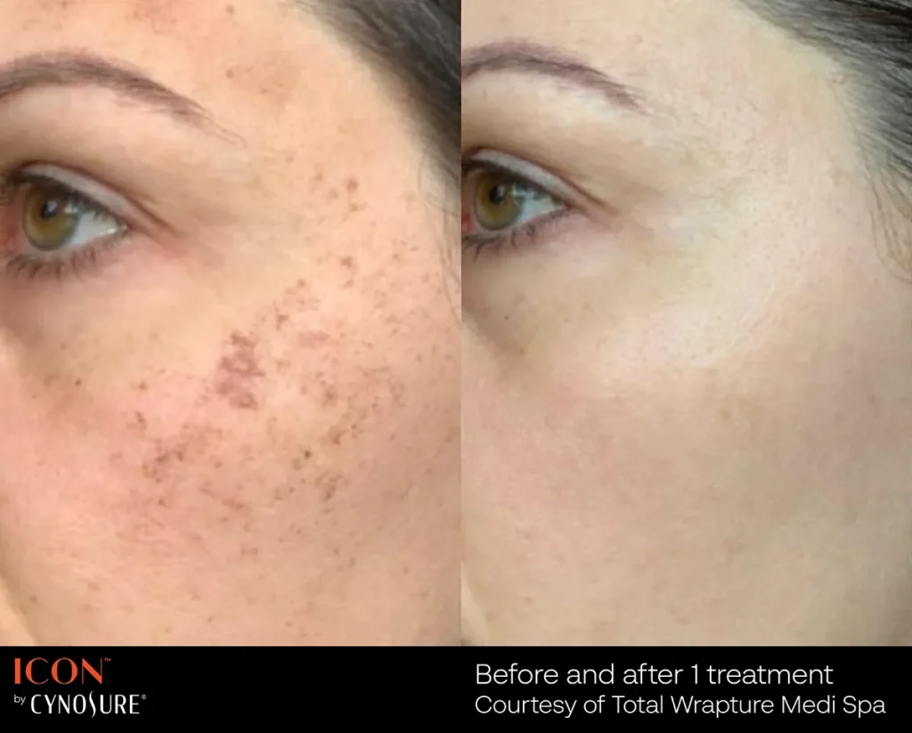 Icon IPL treatment to treat acne scaring and pigmentation issues.