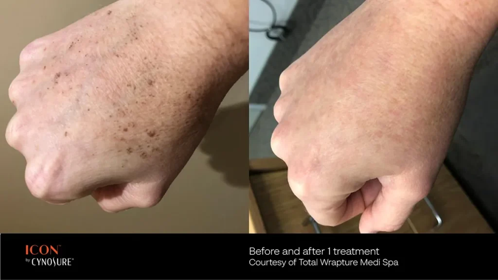 Icon IPL treatment on hands to treat pigmentation issues.