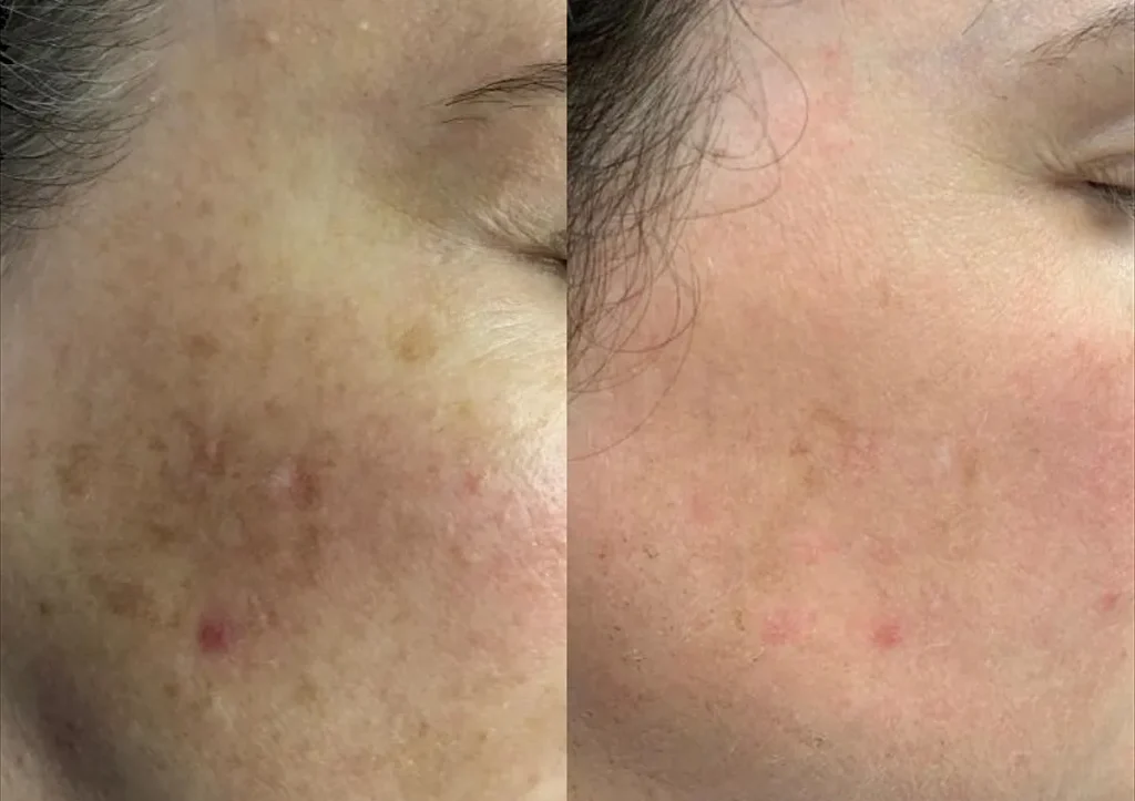 Icon IPL treatment to treat acne scaring and pigmentation issues.
