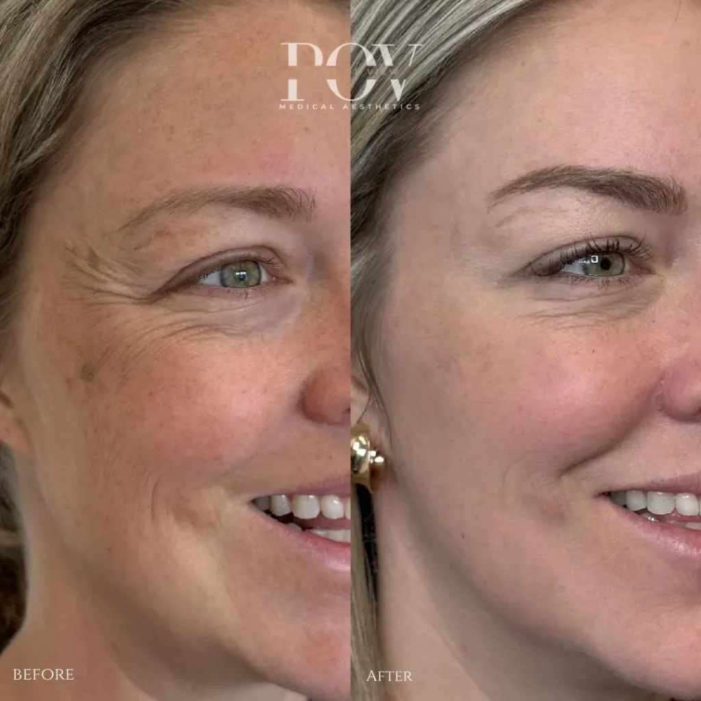 Laser Resurfacing in Calgary at Point of View Medical Aesthetics