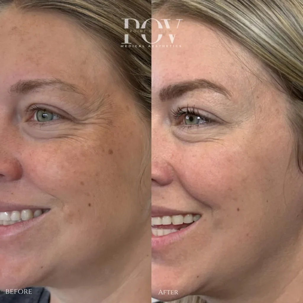 Laser Resurfacing in Calgary at Point of View Medical Aesthetics