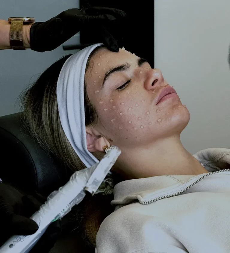 Woman receiving VAMP microneedling treatment at Point of View Medical Aesthetics