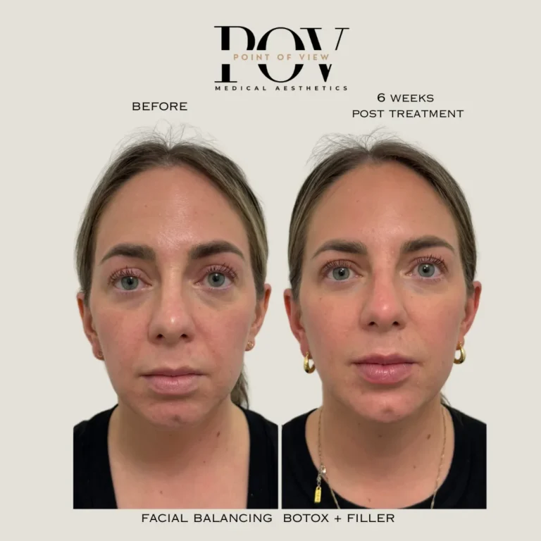 Facial Balancing Botox and Filler2 Facial Balancing with Botox and Filler in Calgary