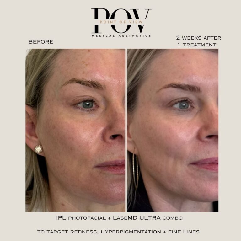Stacked IPL LaseMD Ultra Before After at Point of View Medical Aesthetics in Calgary