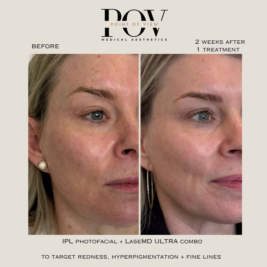 IPL photofacial and LaseMD Ultra Laser Resurfacing before and after