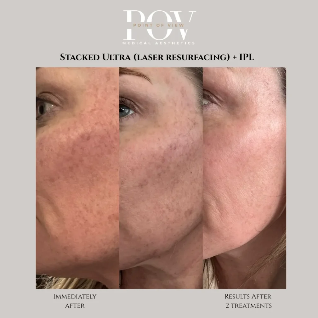 LaseMD Ultra and IPL photofacial at Point of View Medical Aesthetics in Calgary 2 webp