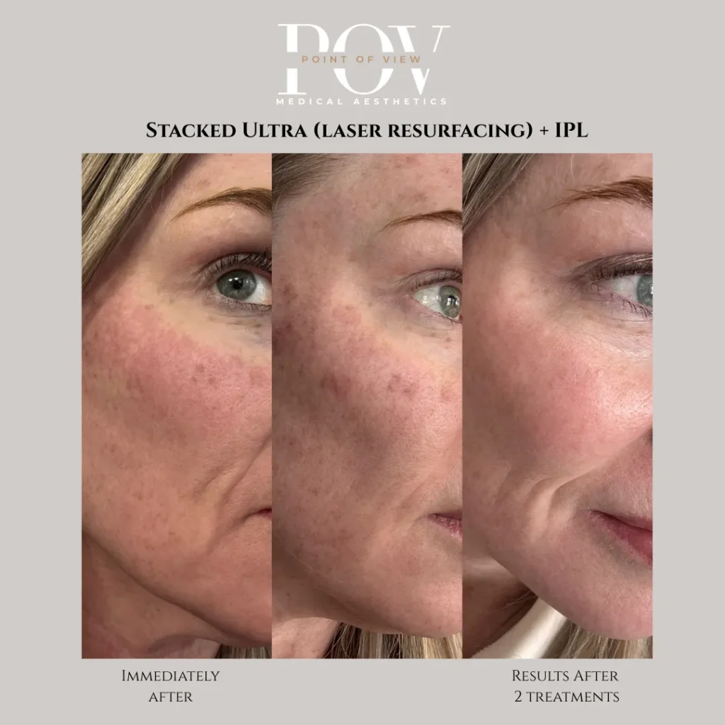 LaseMD Ultra and IPL photofacial at Point of View Medical Aesthetics in Calgary webp